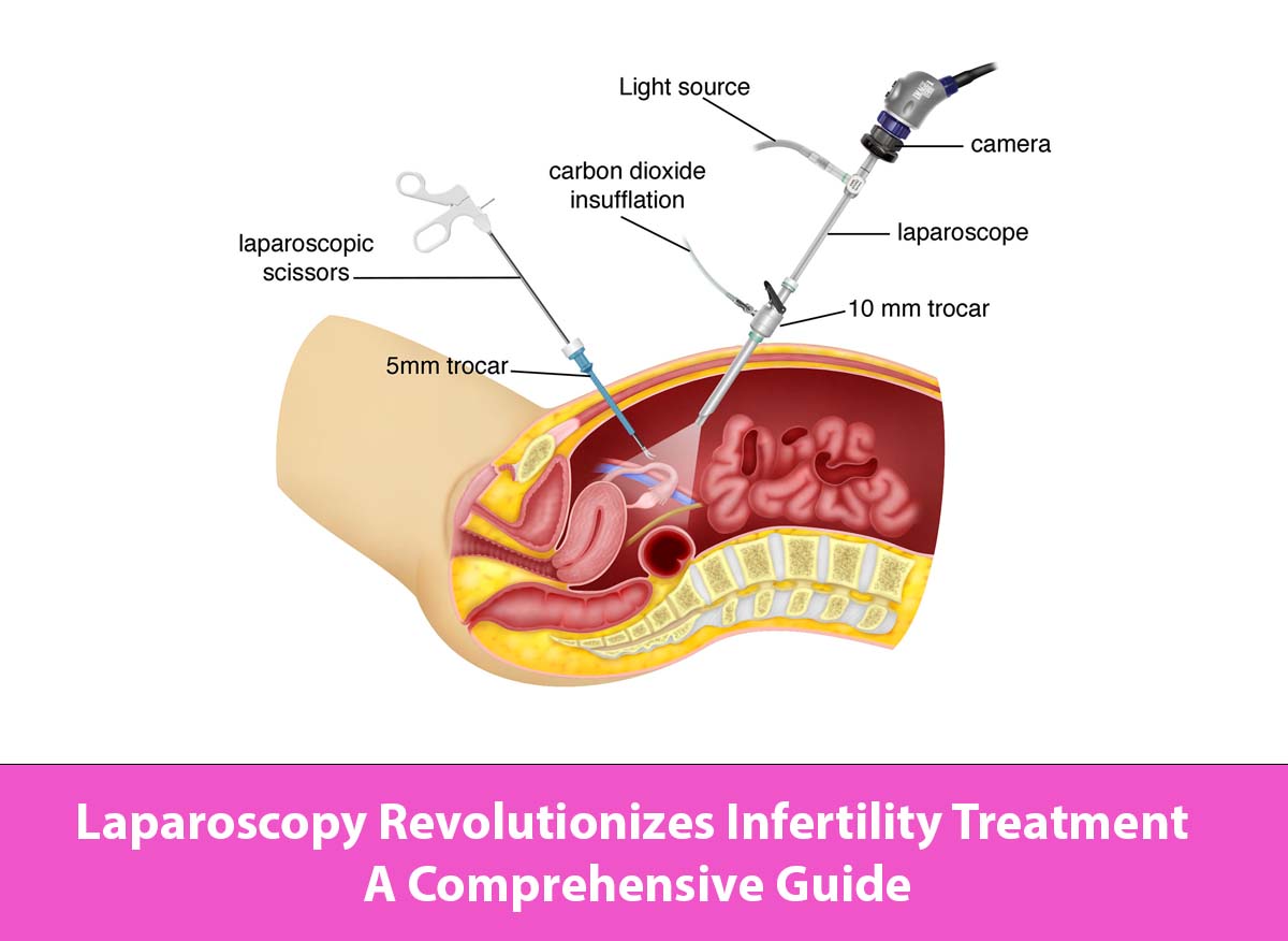 Laparoscopy Revolutionizes Infertility Treatment