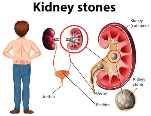 kidney stones in the summer