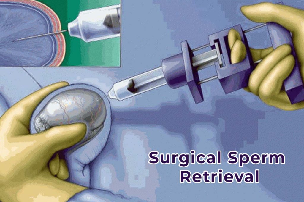 Surgical Sperm Retrieval -IVF Treatment Low Cost in Guntur